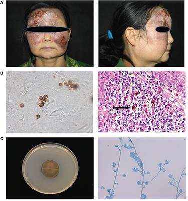 CARD9 deficiency predisposing chromoblastomycosis: A case report and comparative transcriptome study